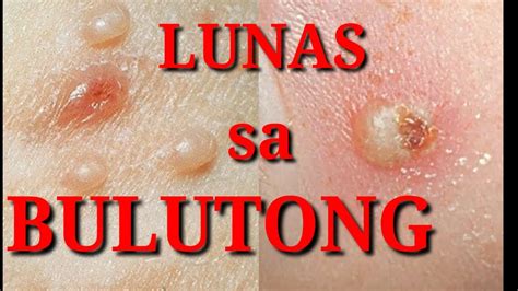 gamot sa bulutong na may nana